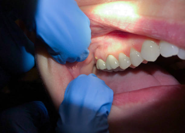 Best Emergency Gum Treatment in Stockbridge, GA